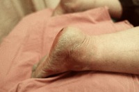 SAVE melanoma project thumbnail