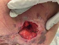 Advances in Wound Care PI dataset project thumbnail