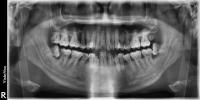Dental Disease Detection project thumbnail