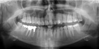 teeths project thumbnail