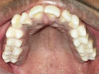 Intra Oral Caries Detector project thumbnail