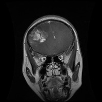 tumor project thumbnail