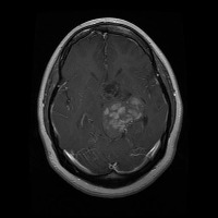 ce-mri brain tumor in fcm svm  project thumbnail