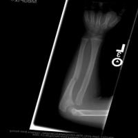 fracture detection a project thumbnail