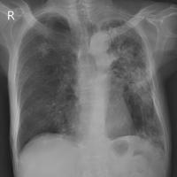 14_classes_wbf_fibrosis project thumbnail