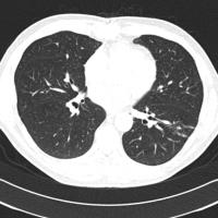 LIDC-IDRI CT Lung Detection 2 project thumbnail