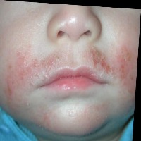 Redness project thumbnail