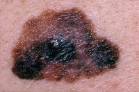 melanoma project thumbnail