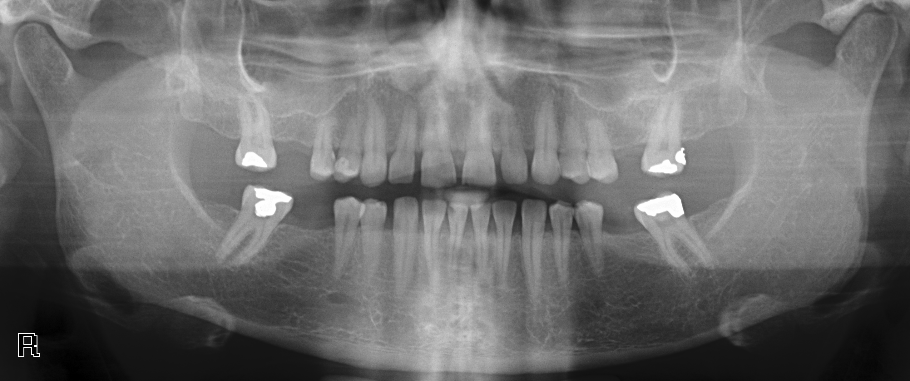 Dental Caries Detection Object Detection Dataset by Panoramic XRay Images