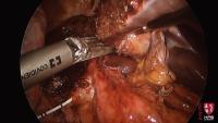 Laparoscopic hepatectomy project thumbnail