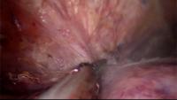 Single-port Laparoscopic L Hepa project thumbnail
