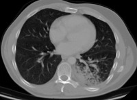 lung_cancer1 project thumbnail