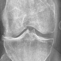 Osteophyte project thumbnail