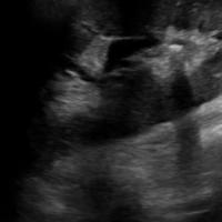 TA-kidney-stone-yolov8 project thumbnail