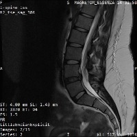 Lumbar-Spine-Diagnosis project thumbnail