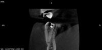 Tomografias coronal project thumbnail