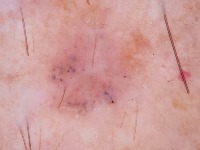 Basal Cell Carcinoma project thumbnail