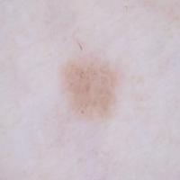 basal cell carcinoma project thumbnail
