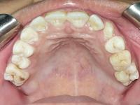 max occlusal project thumbnail