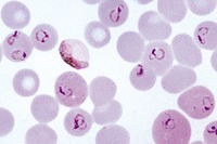 MALARIA PROJECT 2 project thumbnail