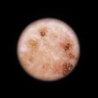 seborrheic keratosis skin cancer Instance Segmentation Model by iitjodhpur
