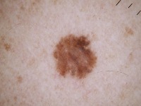 seborrheic keratosis skin cancer Instance Segmentation Model by iitjodhpur