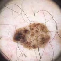 seborrheic keratosis skin cancer Instance Segmentation Model by iitjodhpur