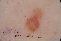 DF cancer project thumbnail
