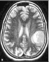 brain tumor project thumbnail