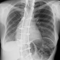 chest-xray-detection project thumbnail