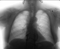 chest-xray-segmentation project thumbnail