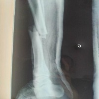 Bone-Fracture project thumbnail