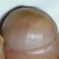 Human Nail Diseases project thumbnail