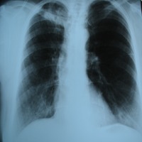 multi-condition-chest-xray project thumbnail