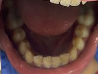 Lower Occlusal project thumbnail
