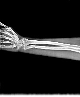 Bone-Fracture Segmentation project thumbnail