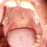 final oral cancer merge project thumbnail