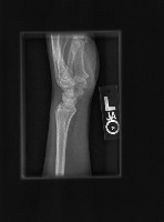 bone fracture detection project thumbnail