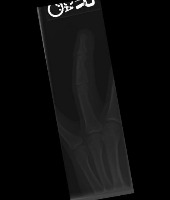 Bone Fracture Data project thumbnail