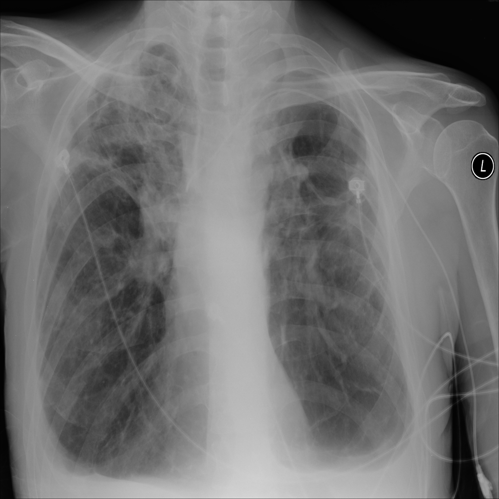 TB TEST Object Detection Dataset By DICOMAnnotations