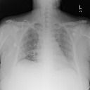 pneumonia project thumbnail