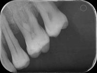 Dental Disease project thumbnail