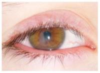 Ocular Rosacea project thumbnail