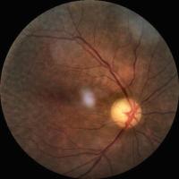 eyepac-light-v2-512-jpg Object Detection Model by yolo