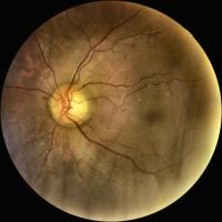 eyepac-light-v2-512-jpg Object Detection Model by yolo