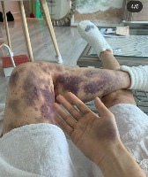 Bruise Detection project thumbnail