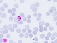 Malaria Detection project thumbnail