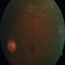 diabetic retinopathy Object Detection Dataset by Beyda
