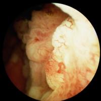 Bladder Lesion Segmentation project thumbnail