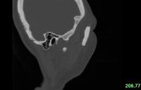 PG7-ZhangXianFeng\Sagittal110 project thumbnail